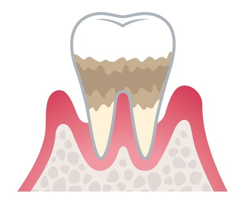 中等度歯周病（歯周炎）の場合